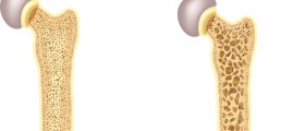 Menopause And Osteoporosis: What Every Menopausal Woman Should Know To Boost Her Bone Health